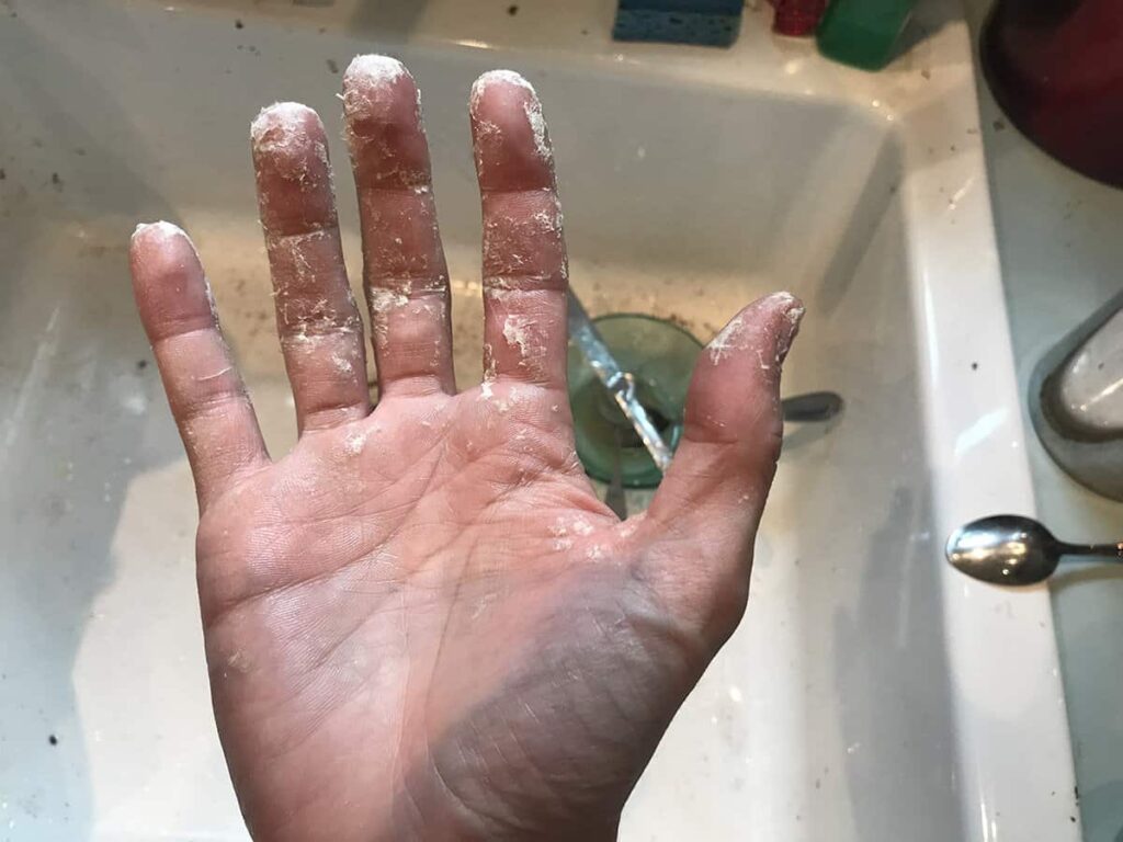 Hand with dried spray foam stuck on skin